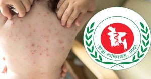 হাম ও হামের উপসর্গে আরও ৭ শিশুর মৃত্যু