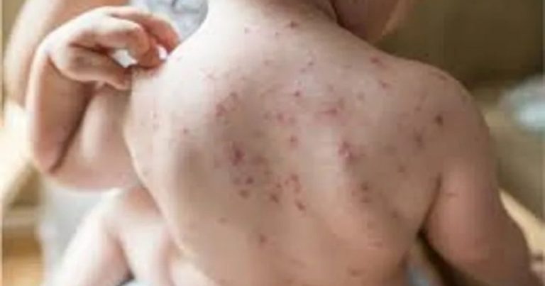 হামে ২৪ ঘণ্টায় আরও ৩ মৃত্যু, আক্রান্ত ৯৪৭