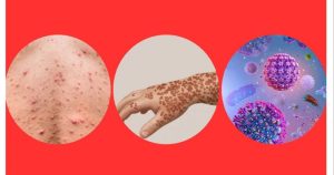 ঢাকাসহ ৪ সিটিতে আজ শুরু হামের টিকাদান কর্মসূচি