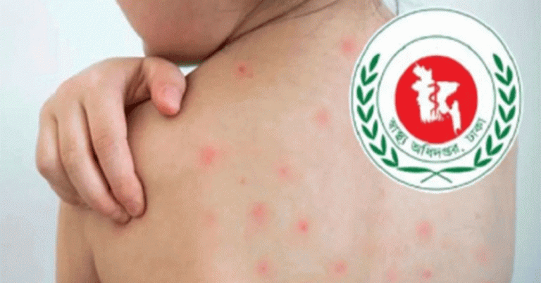 হাম ও হামের উপসর্গে প্রাণ গেলো আরও ৬ শিশুর