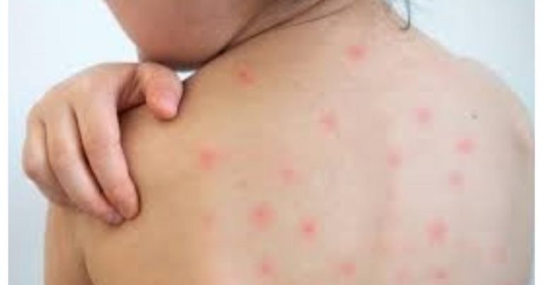 হাম উপসর্গে আরও ৩ শিশুর মৃত্যু